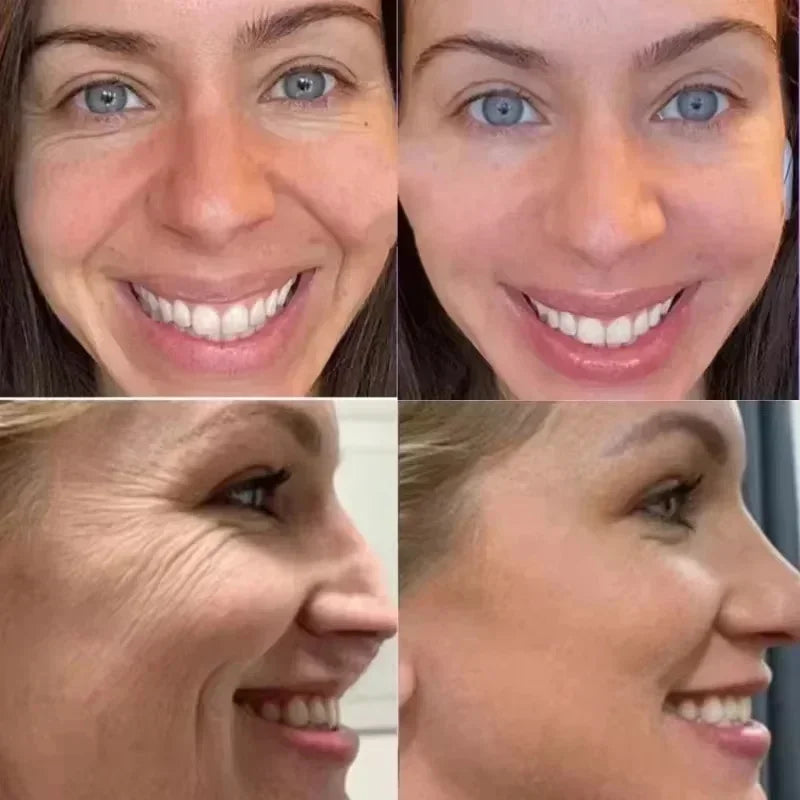 Hyaluronic Acid Anti-Wrinkle Nasolabial Mask Deep Hydration Nourishing Repair Firming Lifting Fade Fine Lines Korean Skincare