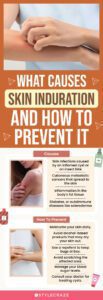 How To Get Rid Of Indurated Skin